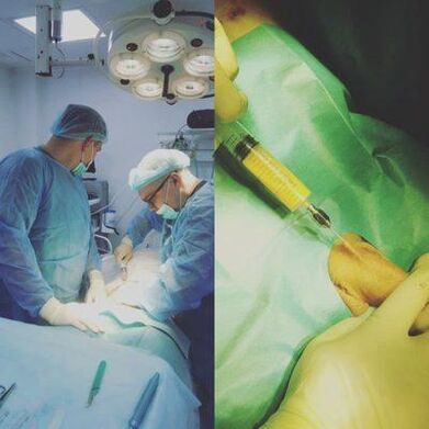 Dzimumlocekļa sabiezēšana ir iespējama ar operācijas palīdzību